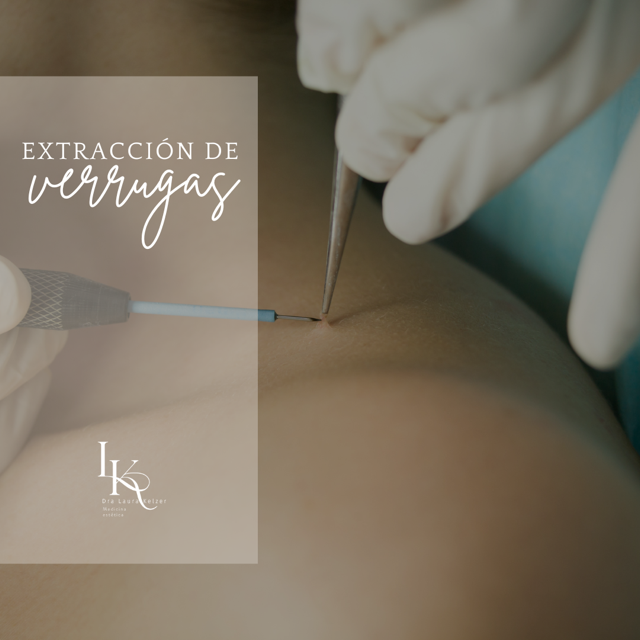 extraccion-de-verrugas