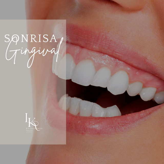 sonrisa gingival